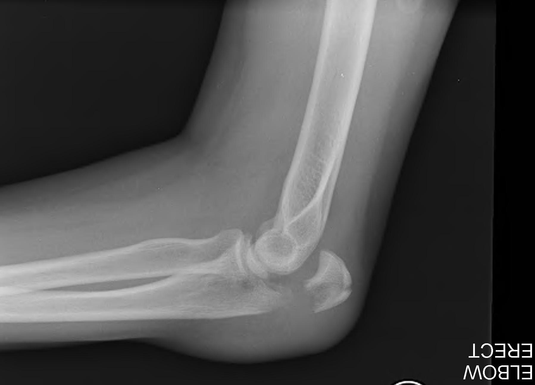 Elbow Olecranon Fracture